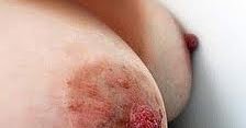 Neurodermatitis alladulto